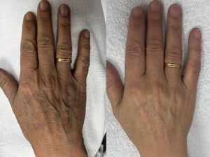 Rejuvenecimiento Manos