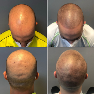 Micropigmentación capilar