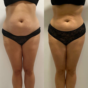 Mesoterapia Corporal