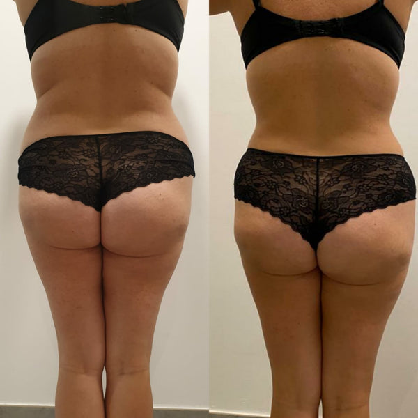 Mesoterapia Corporal