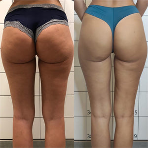 Radiofrecuencia Indiba Corporal