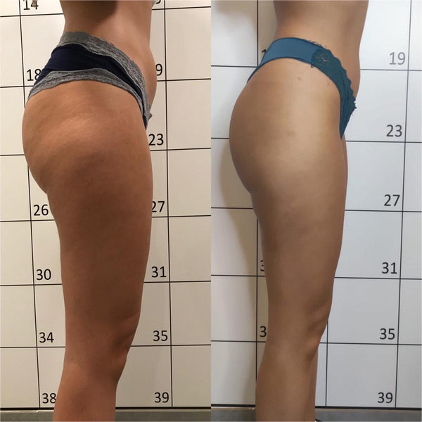 Radiofrecuencia Indiba Corporal