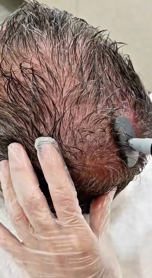 Radiofrecuencia Indiba capilar