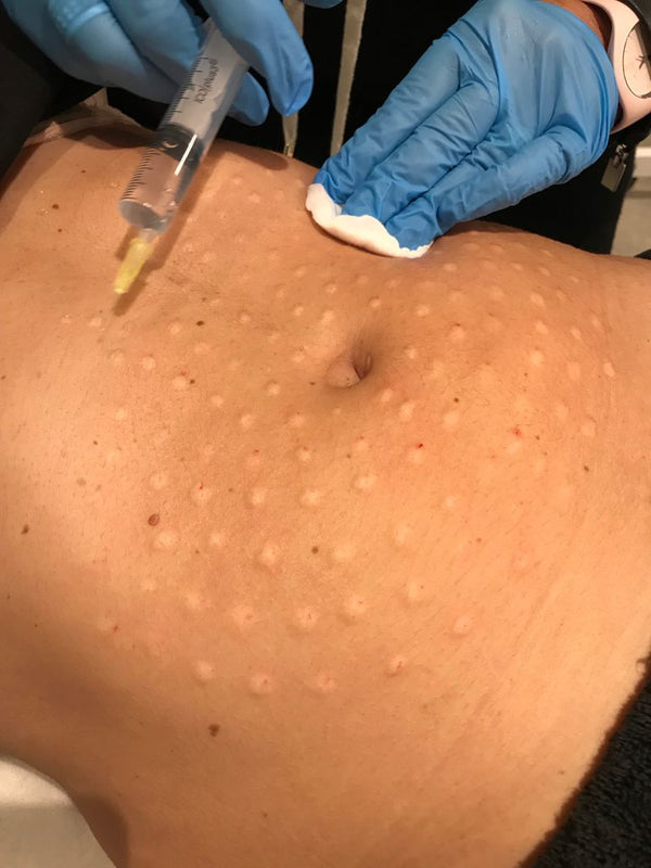 Mesoterapia Corporal