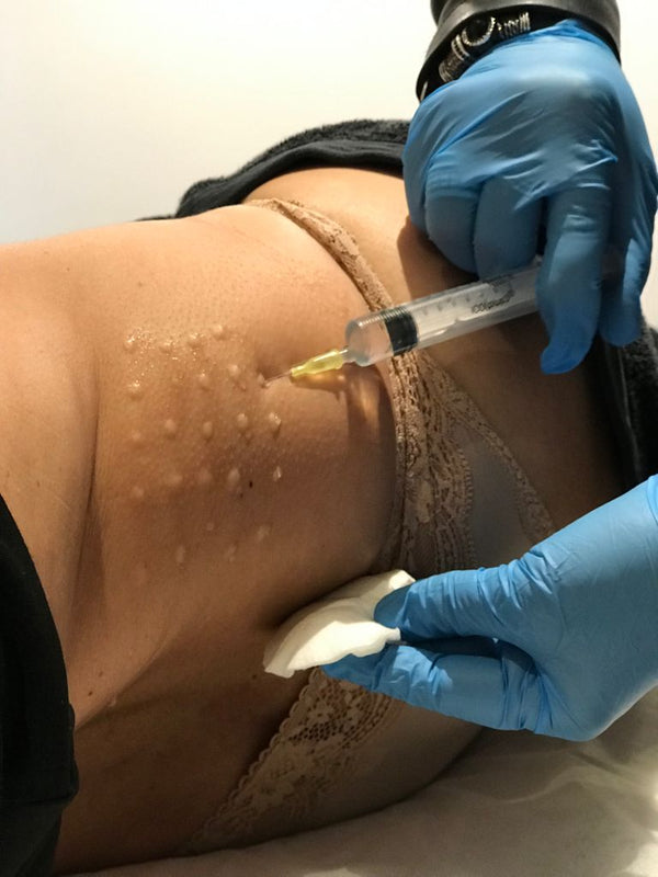 Mesoterapia Corporal