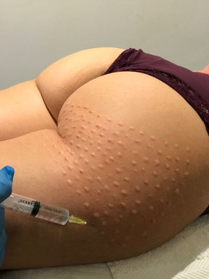 Mesoterapia Corporal