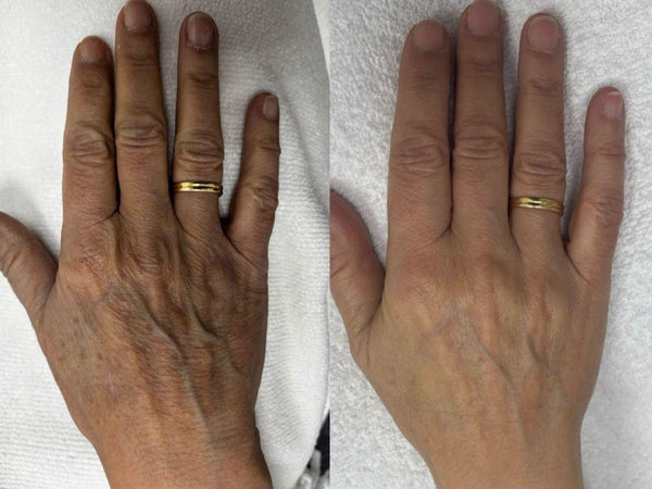 Rejuvenecimiento Manos