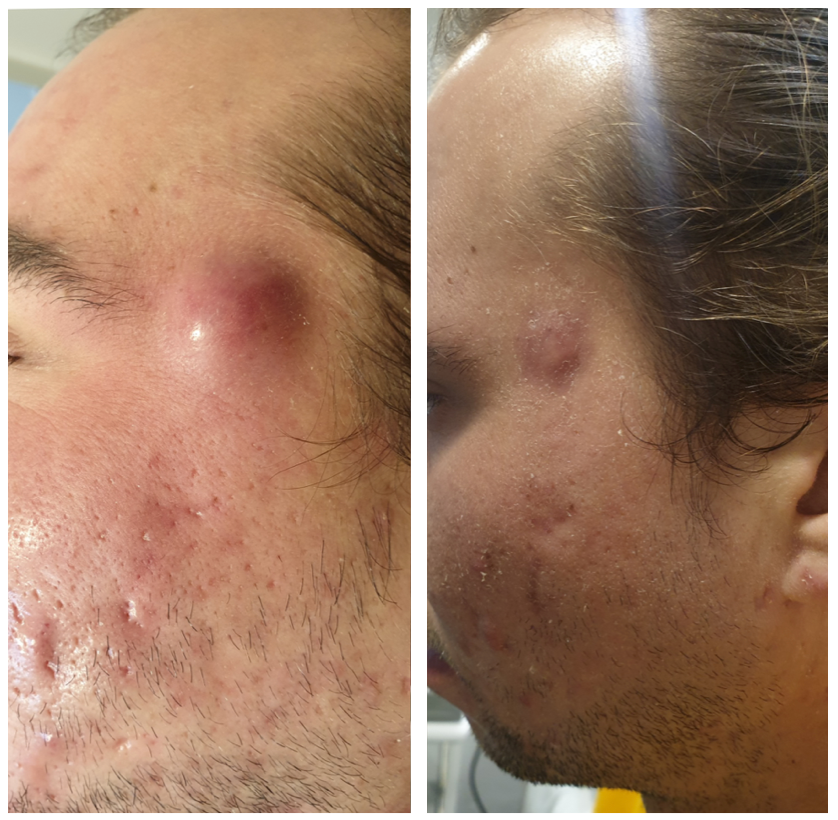Dual Acne (Laser)