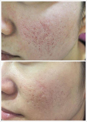 Venus Viva (Marcas, Poro y cicatrices)