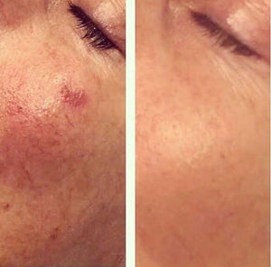 Láser IPL (Manchas)