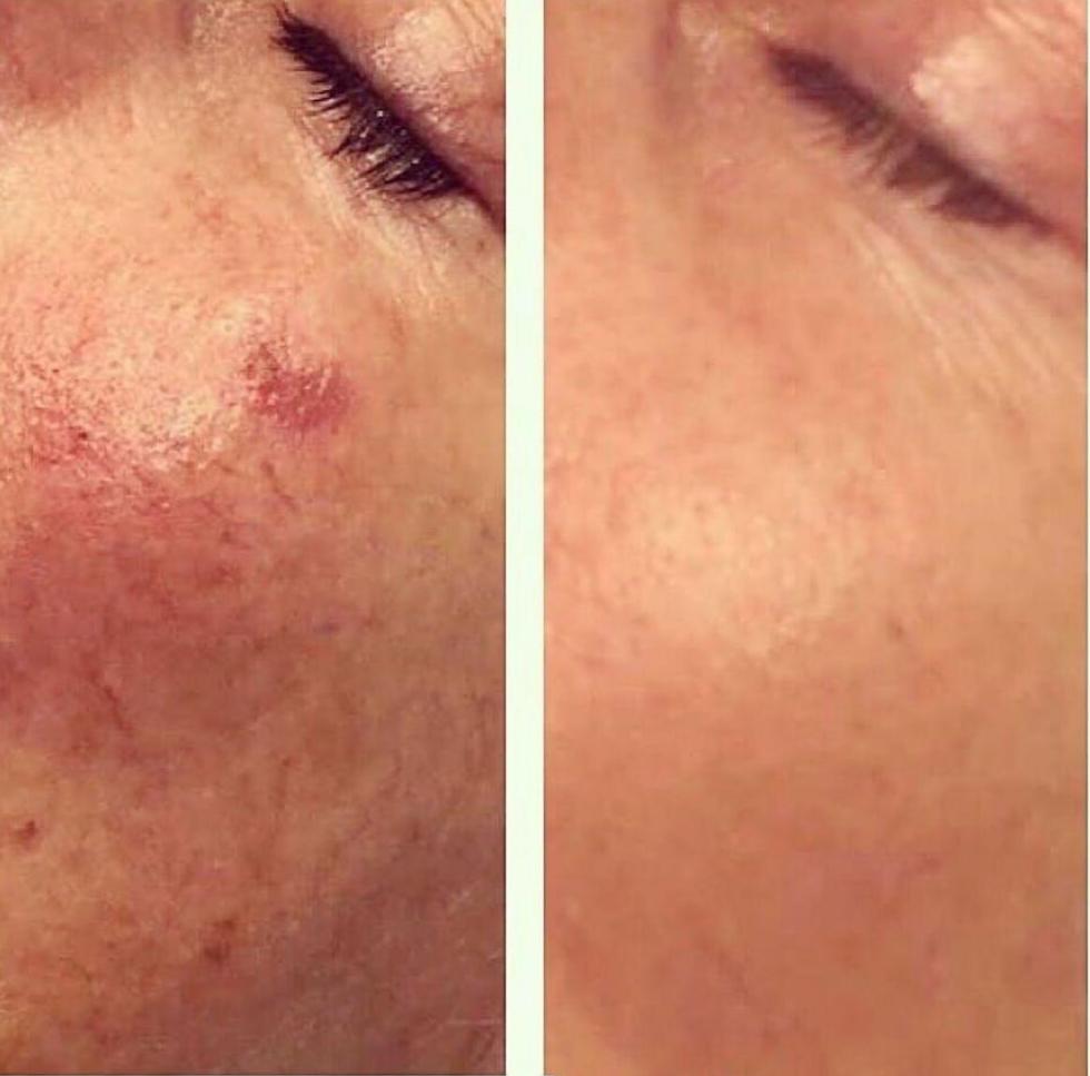 IPL Laser (Dark Spots)