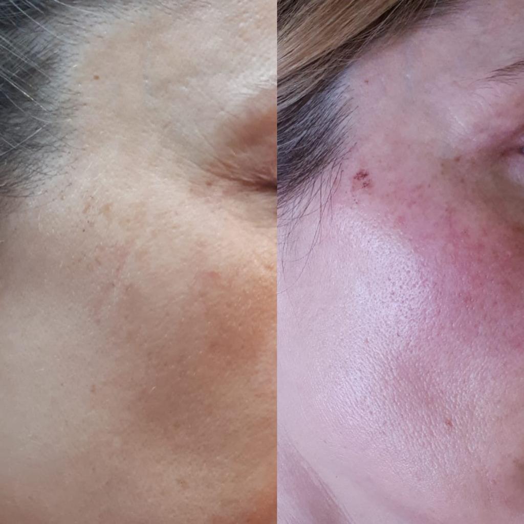 IPL Laser (Dark Spots)