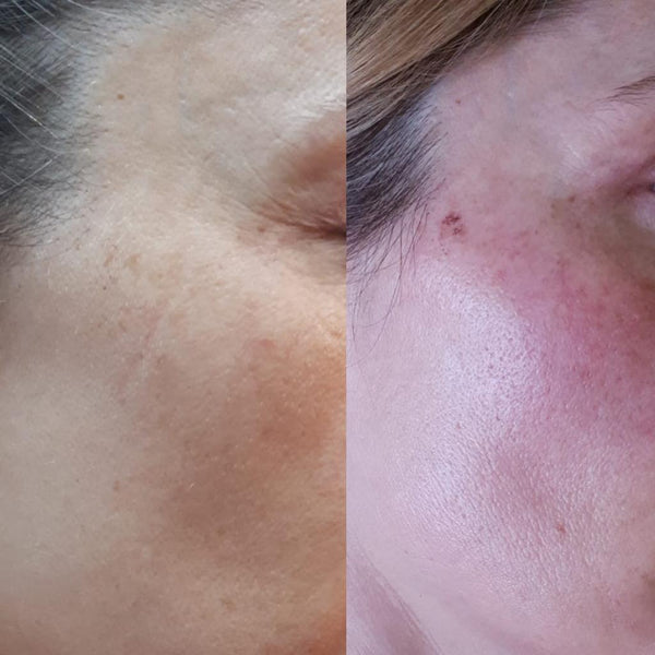 Láser IPL (Manchas)