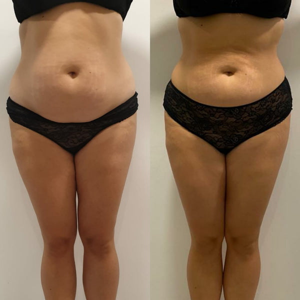 Mesoterapia Corporal