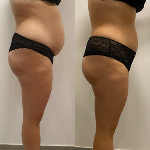 Mesoterapia Corporal