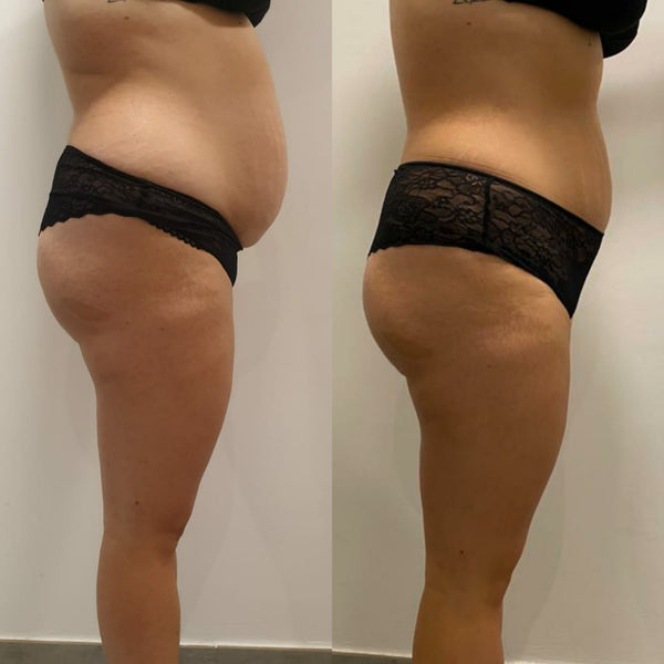 Mesoterapia Corporal