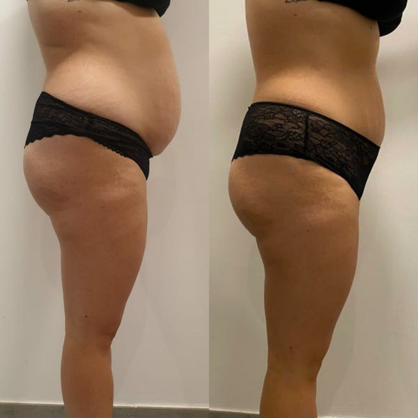 Mesoterapia Corporal