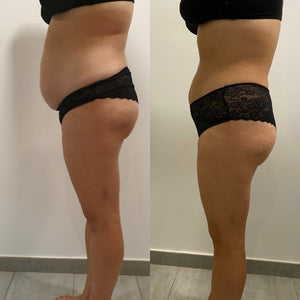 Mesoterapia Corporal