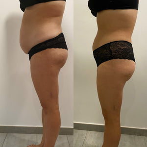 Mesoterapia Corporal