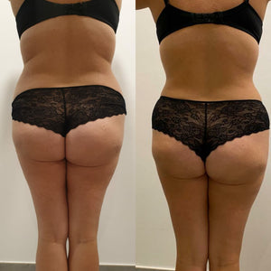 Mesoterapia Corporal