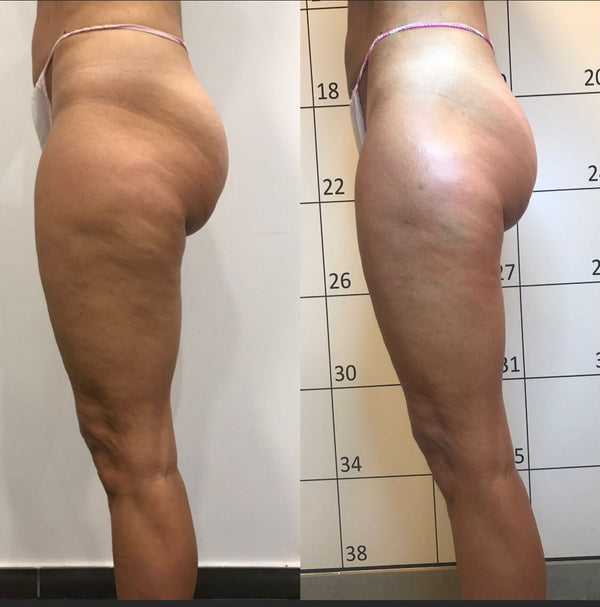 Presoterapia (Ballancer)