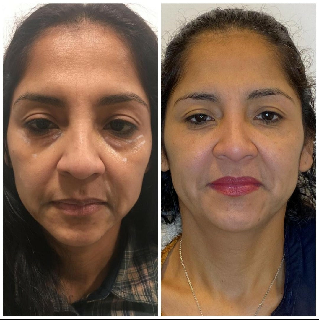 Hyaluronic Acid 6 Points (Full Face)
