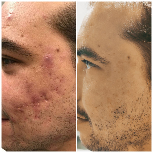 Venus Viva (Marcas, Poro y cicatrices)