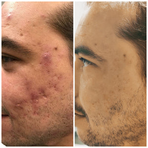 Venus Viva (Marcas, Poro y cicatrices)