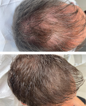 Micropigmentación capilar